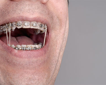Elastics for Braces, Explained.